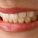 veneer tech