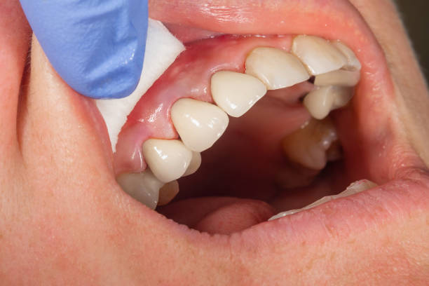 veneer tech